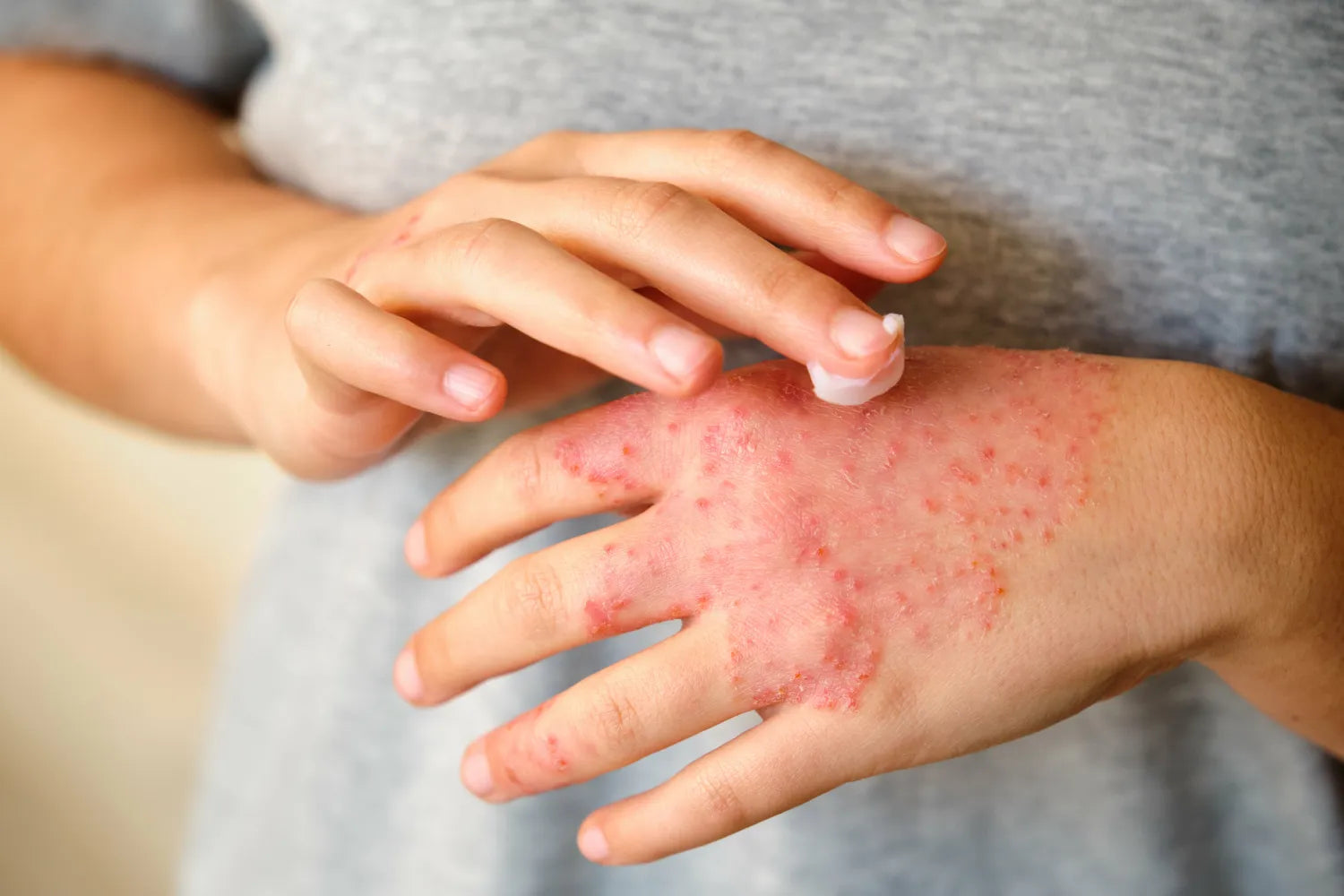 Eczema and Gut Health: What Does the Research Say?