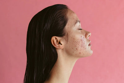 Gut Health and Acne: What Does the Science Say?